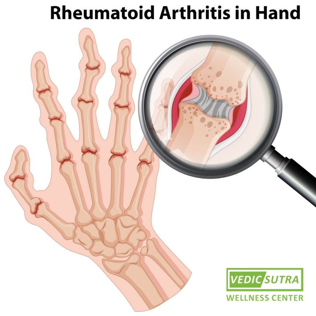Rheumatoid arthritis