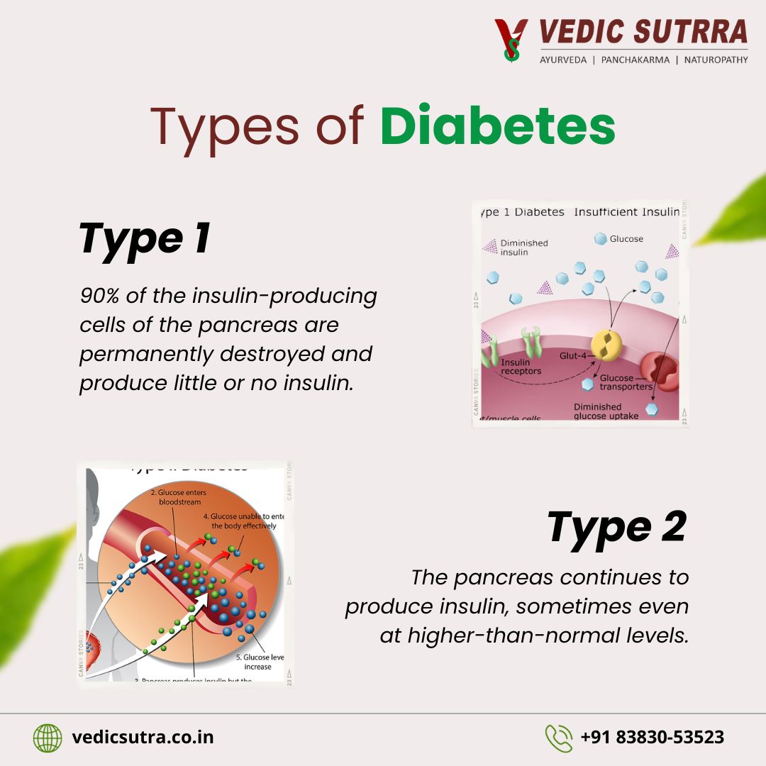 Types of Diabetes