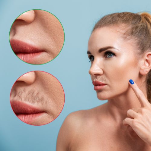 Hirsutism Excess Hair Growth