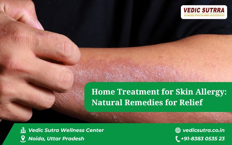 Home Treatment for Skin Allergy Natural Remedies for Relief